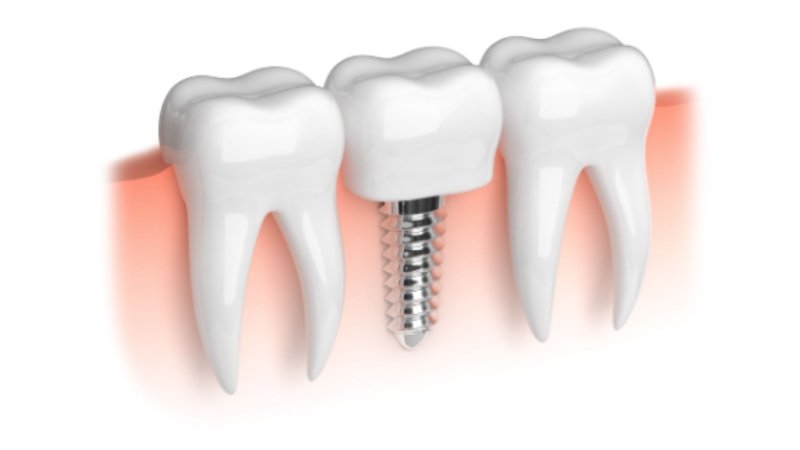 Why Is Gum Health So Important for Dental Implant Success?